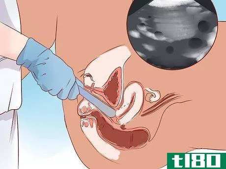 Image titled Detect an Ectopic Pregnancy Step 7
