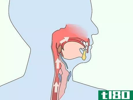 Image titled Diagnose Esophageal Diverticulum Step 4