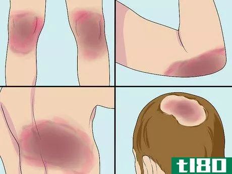 Image titled Diagnose Erythrodermic Psoriasis Step 8