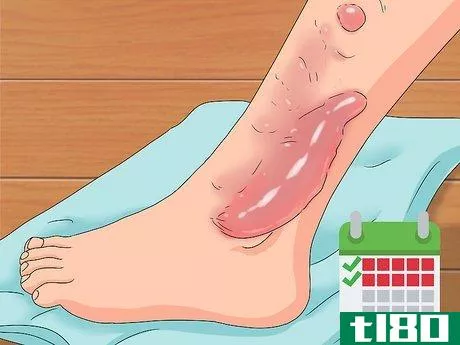 Image titled Determine if a Burn Is Infected Step 7