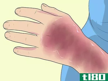 Image titled Diagnose Erythrodermic Psoriasis Step 6