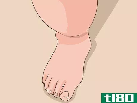 Image titled Diagnose Lipedema Step 5