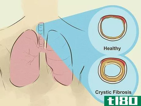 Image titled Diagnose Lung Hyperinflation Step 10