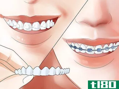 Image titled Determine if You Need Braces Step 18
