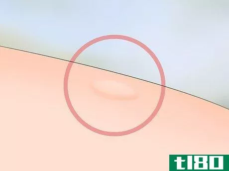 Image titled Identify Tick Bites Step 2