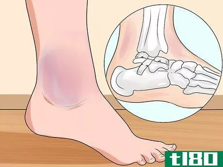 Image titled Know if You've Sprained Your Ankle Step 6