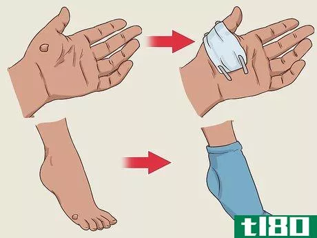 Image titled Get a Wart Surgically Removed Step 4