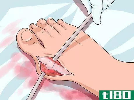 Image titled Get Rid of Bunions Step 11