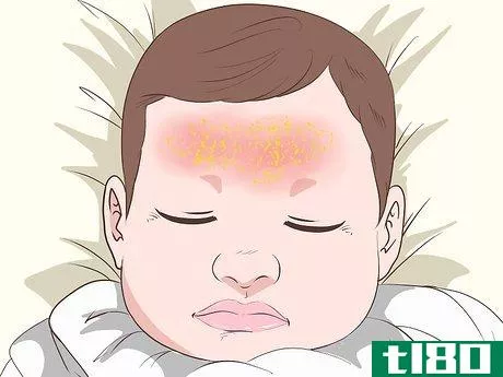 Image titled Identify and Treat Different Types of Diaper Rash Step 8