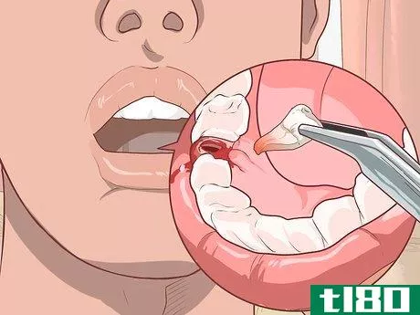 Image titled Prepare for Tooth Extraction Step 1