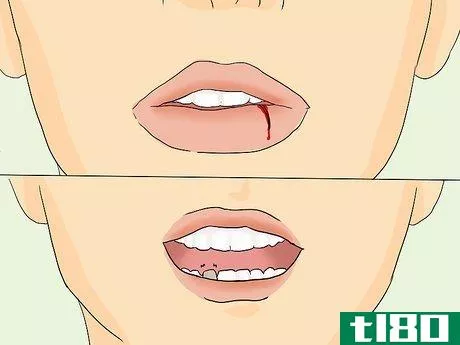 Image titled Heal a Swollen Lip Step 13