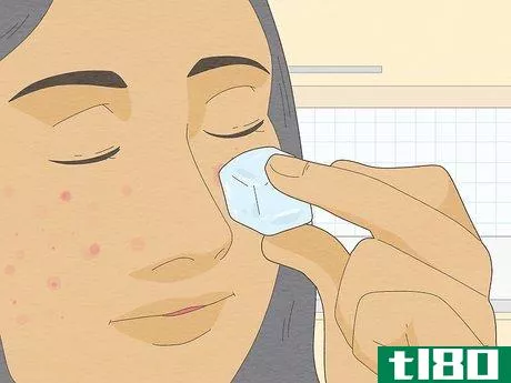 Image titled Get Rid of a Popped Pimple Overnight Step 1