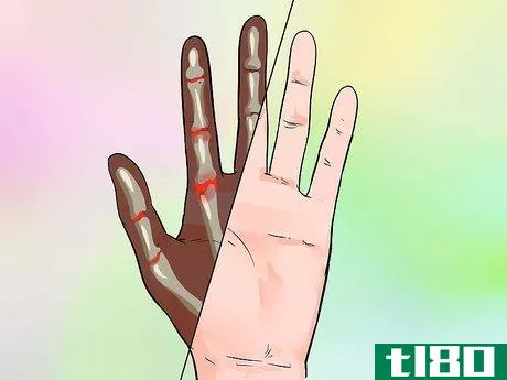 Image titled Know if You Have Trigger Finger Step 8