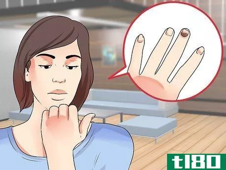 Image titled Know if You Have Nail Fungus Step 4