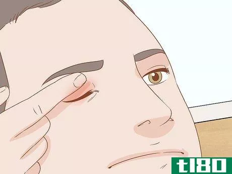 Image titled Heal a Swollen Eyelid Step 10