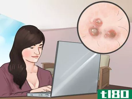 Image titled Know If You Have Herpes Step 8