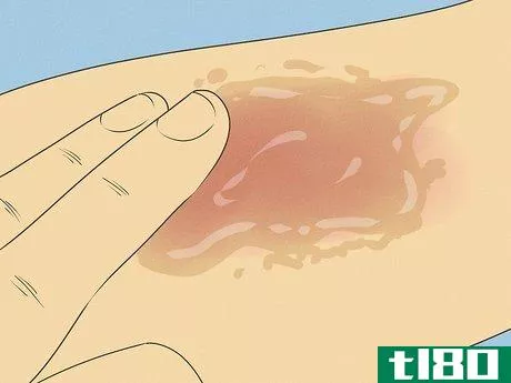 Image titled Improve Eczema with Diet Step 3
