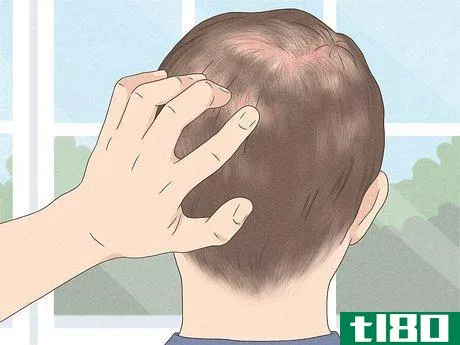 Image titled Know if You Have Male Pattern Baldness Step 4