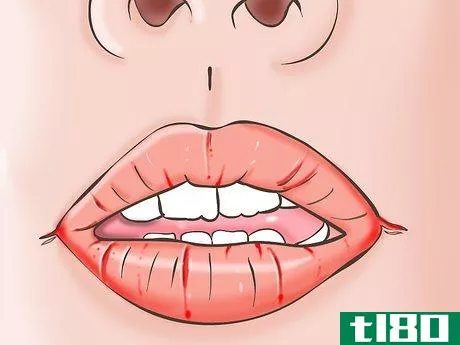 Image titled Know if You Have Oral Thrush Step 2