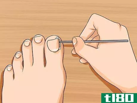 Image titled Relieve Ingrown Toe Nail Pain Step 17