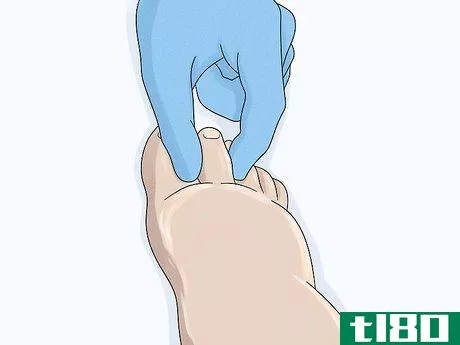 Image titled Identify Lymphedema Step 7