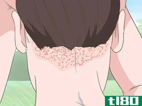 如何治愈头皮湿疹(heal scalp eczema)