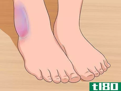Image titled Know if You've Sprained Your Ankle Step 2