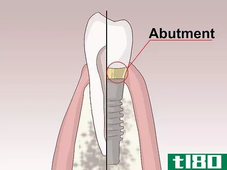 Image titled Know What to Expect when Getting a Tooth Implant Step 13