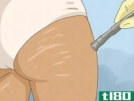 Image titled Get Rid of Stretch Marks Step 11