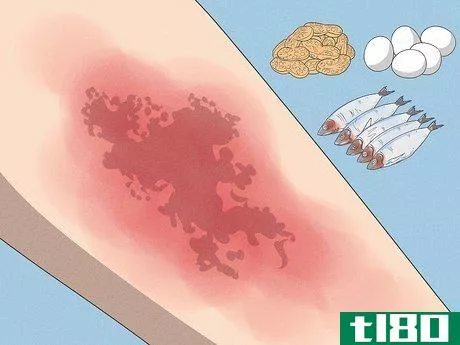 如何通过饮食改善湿疹(improve eczema with diet)