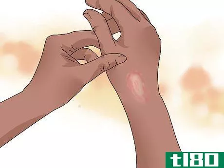 Image titled Identify and Treat Ringworm Step 4