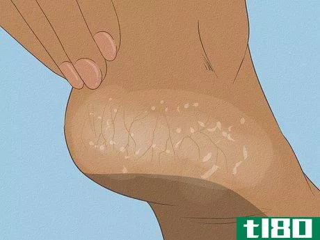 Image titled Get Rid of Dry Skin on Feet Step 2