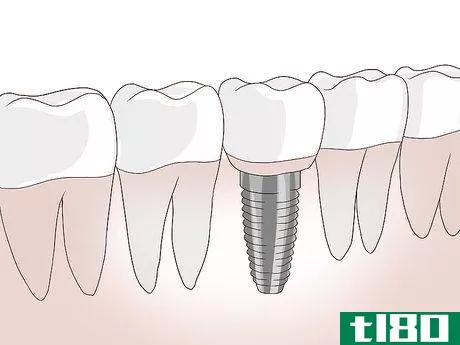 Image titled Know What to Expect when Getting a Tooth Implant Step 2