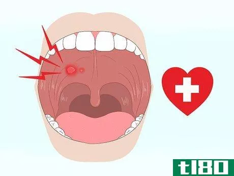 Image titled Get Rid of Mouth Blisters Step 19