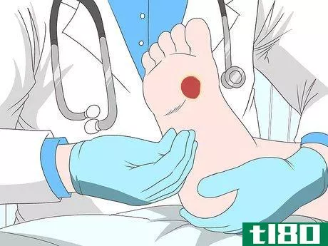 如何治疗足部溃疡(heal foot ulcers)