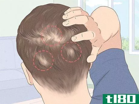 Image titled Know if You Have Male Pattern Baldness Step 2