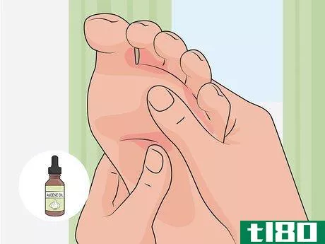 Image titled Get Rid of Foot Fungus at Home Step 07