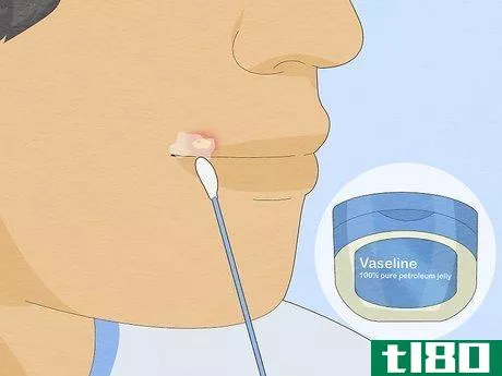 Image titled Get Rid of a Cold Sore Fast Step 8