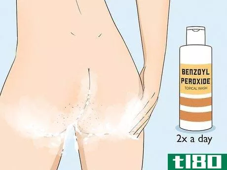 Image titled Get Rid of Acne on the Buttocks Step 8