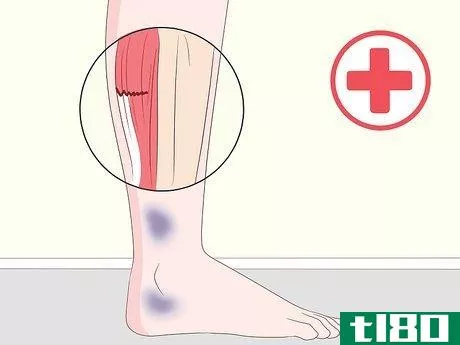 Image titled Get Rid of Leg Pain Step 13