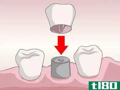 Image titled Know What to Expect when Getting a Tooth Implant Step 17