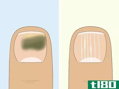 Image titled Heal Damaged Nails Step 1