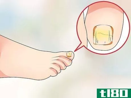 Image titled Know if You Have Nail Fungus Step 3