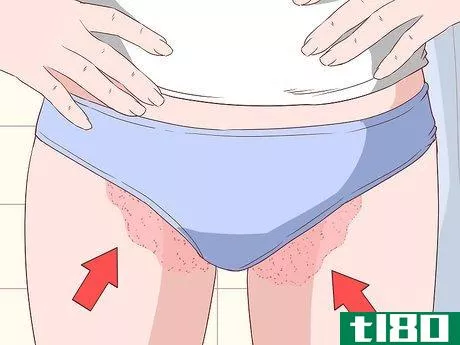 Image titled Know if You Have Jock Itch Step 1