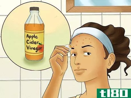 Image titled Get Rid of Forehead Acne Step 6
