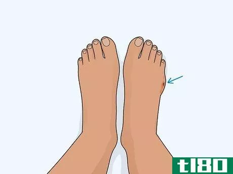 如何治疗脚趾损伤(heal a toe injury)
