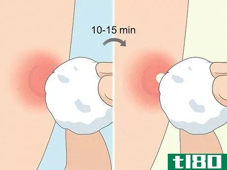 Image titled Instantly Get Rid of a Pimple (Cotton Ball Popping Method) Step 3