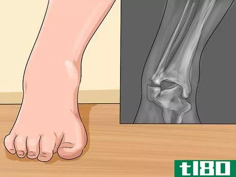 Image titled Know if You've Sprained Your Ankle Step 9