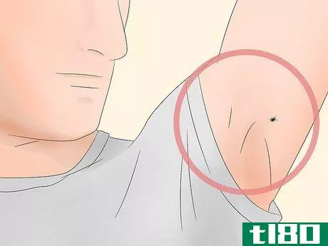 Image titled Identify Tick Bites Step 1