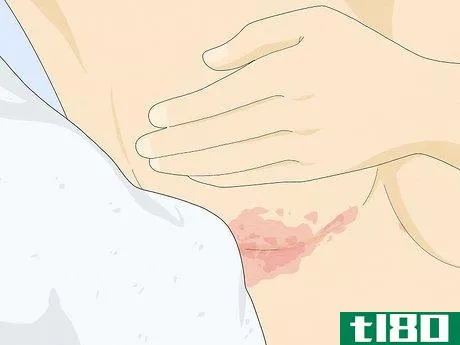 Image titled Heal Raw Skin Step 15